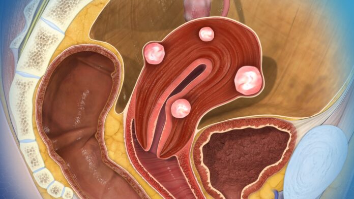 uterinefibroids