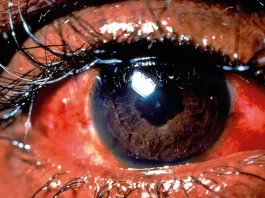 Infected eye