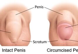 Circumcision