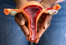 Silent Threat: Raising Awareness about Ovarian Cancer in Uganda